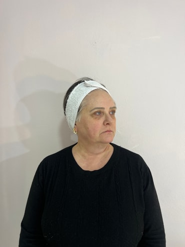 Paciente antes da harmonização facial - lado esquerdo